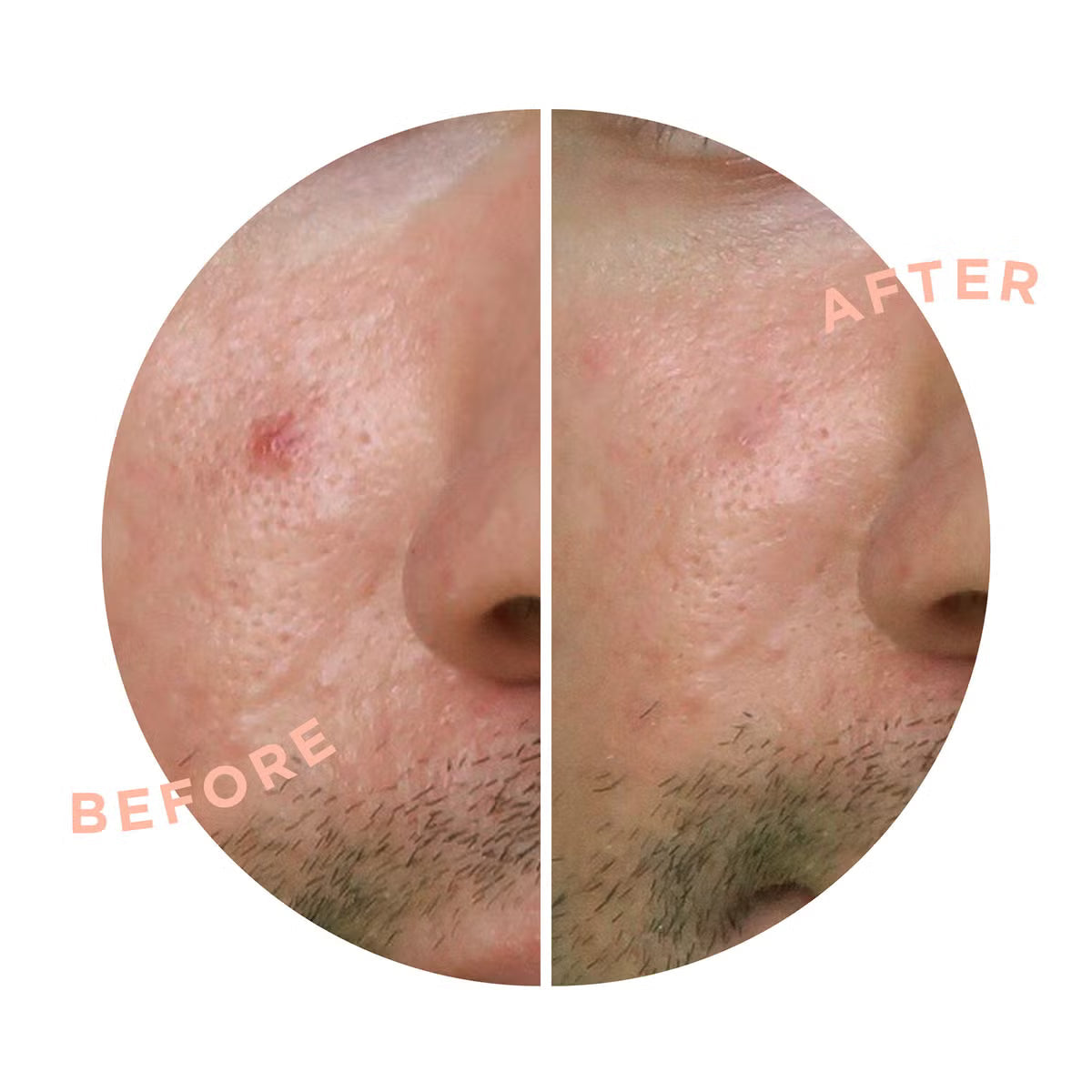 ZITSTICKA Spot Clarifying Patch Kit