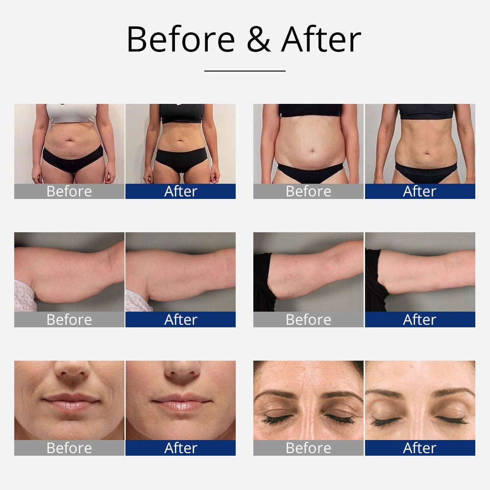 Shape Tactics 4-in-1 Cavitation, RF, and EMS Body Sculpting System