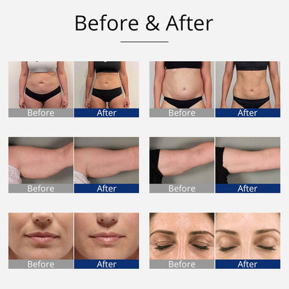 Shape Tactics 4-in-1 Cavitation, RF, and EMS Body Sculpting System