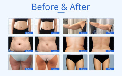 Shape Tactics 6-in-1 Unoisetion Cavitation 2.0 Vacuum RF System