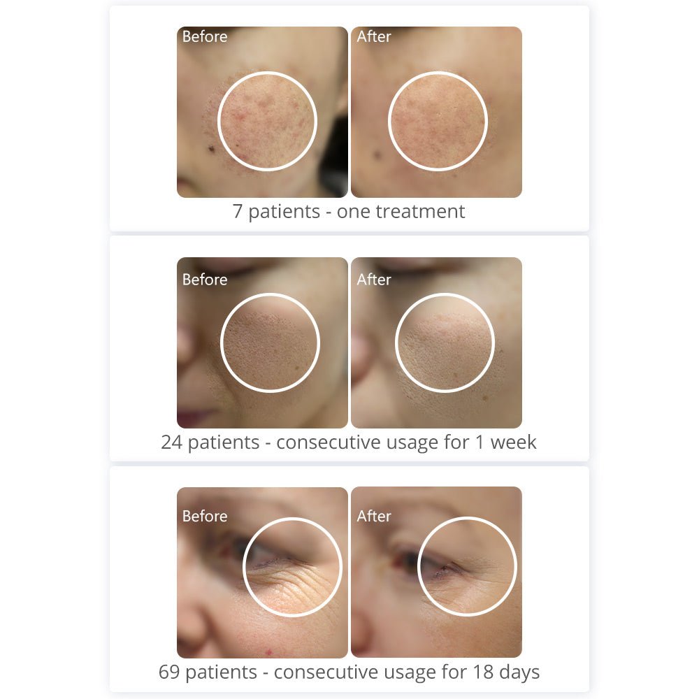 Shape Tactics PDT 408 LED Light Therapy System